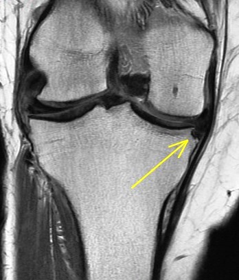 Figure 2 for case chondrocalcinosis within chronic unstable medial meniscus flap tear and adjacent tibial remodeling ( RID5398 )